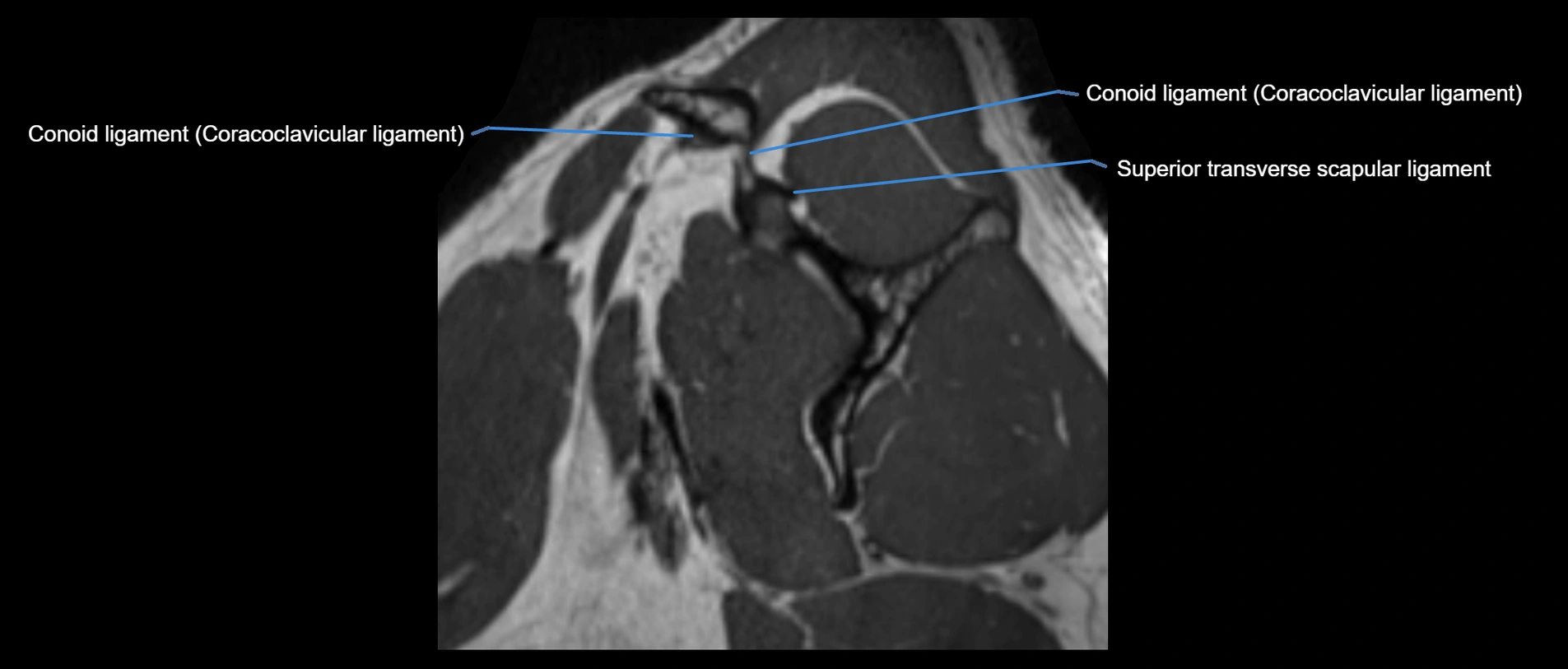 shoulder ligaments sagittal  cross sectional anatomy 3T MRI AI enhanced radiology image -img-00001-00011.webp